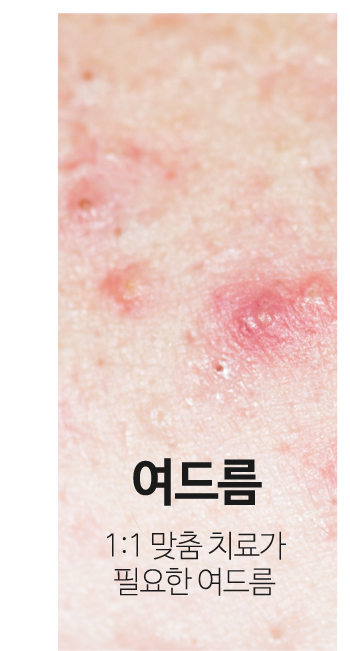 여드름